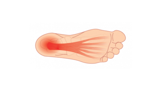 Plantar Fasciitis