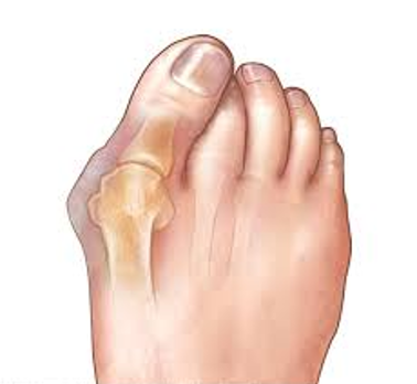 Bunion (Hallux Valgus)