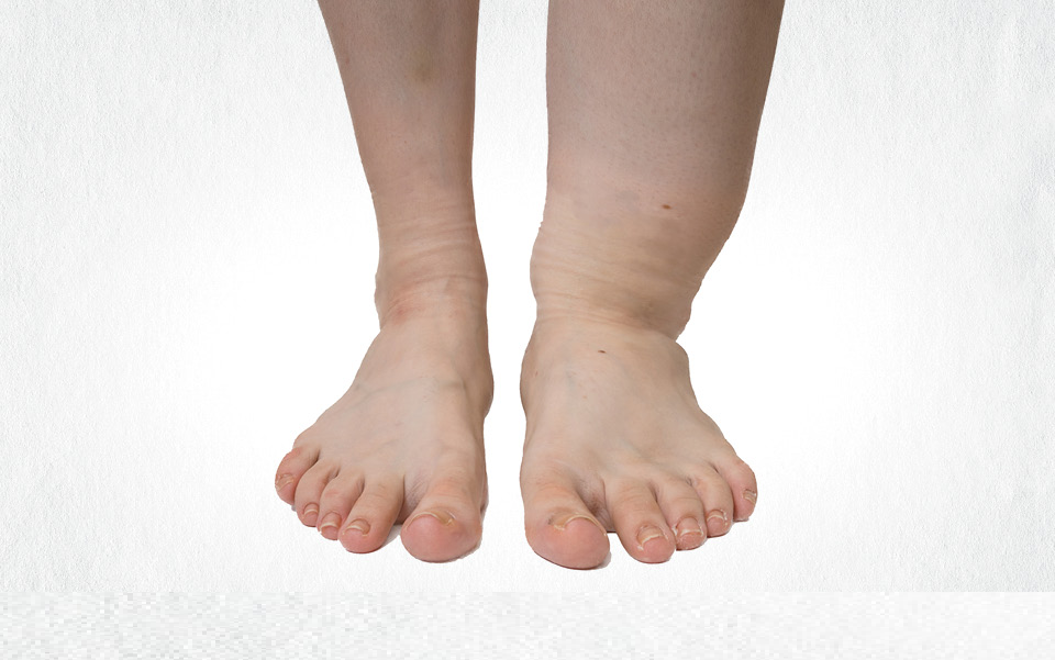 Lymphedema/Swollen